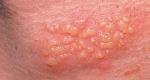 Mụn rộp sinh dục (Herpes sinh dục)